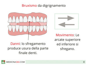 bruxismo-da-digrignamento